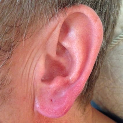 earlobe plumping after