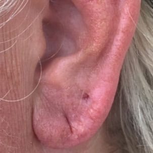 earlobe plumping after