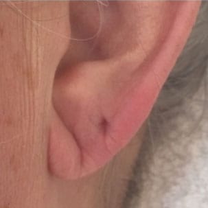 earlobe plumping before