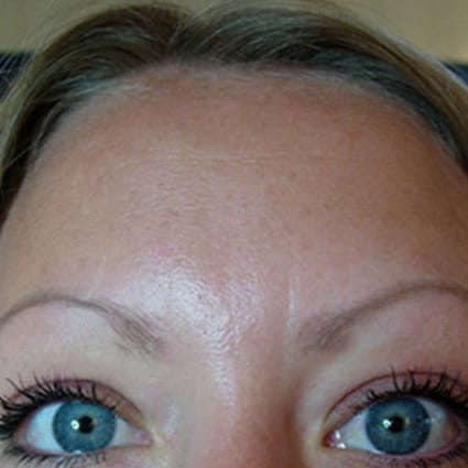 forehead botox after