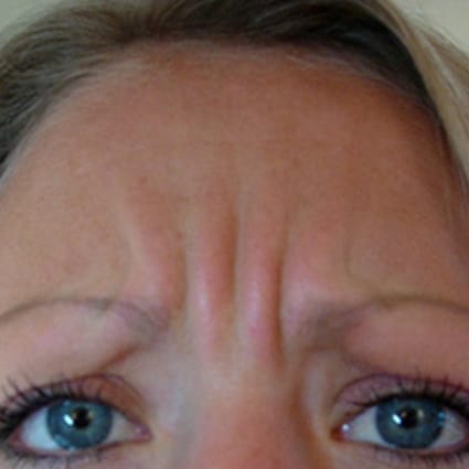 forehead botox before