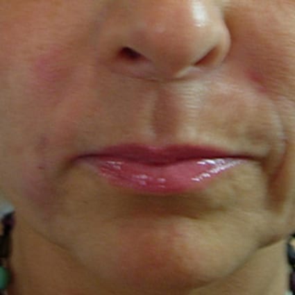 lip enhancement after