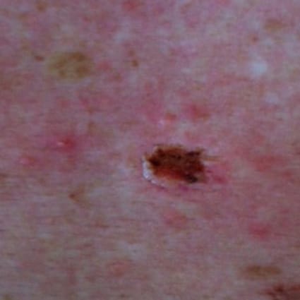mole & skin tag removal after
